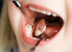 цены на лечение кариеса зубов