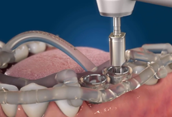 Хирургический шаблон и технология MIS MGUIDE